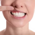 Frau zeigt Zahnfleisch mit Gingvitis